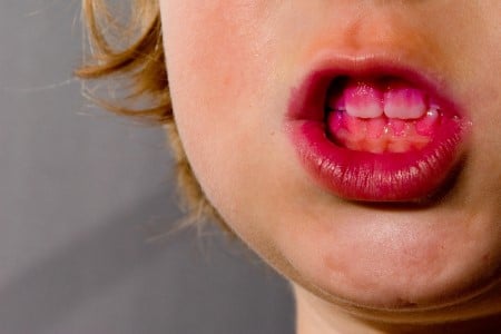 An open mouth showing pink-coloured dye over areas of plaque on teeth