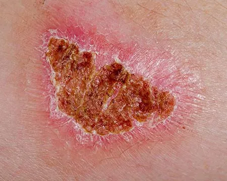 A scab on a healing wound