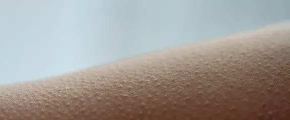 Goosebumps on skin