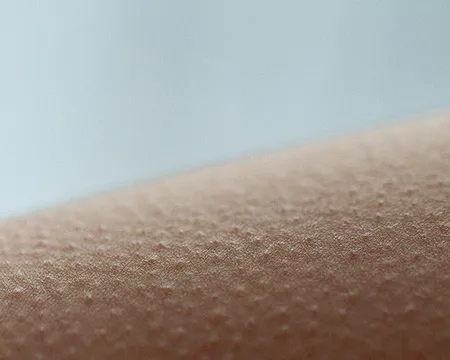 Goosebumps on skin